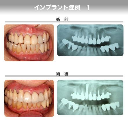 インプラント症例1